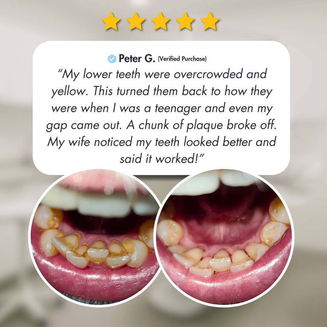 Ultrasonic Teeth Cleaner