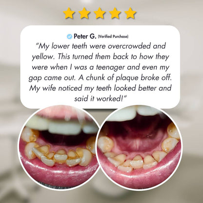 Ultrasonic Teeth Cleaner