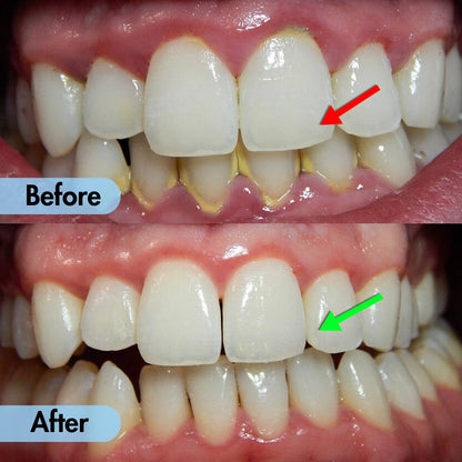 Ultrasonic Teeth Cleaner