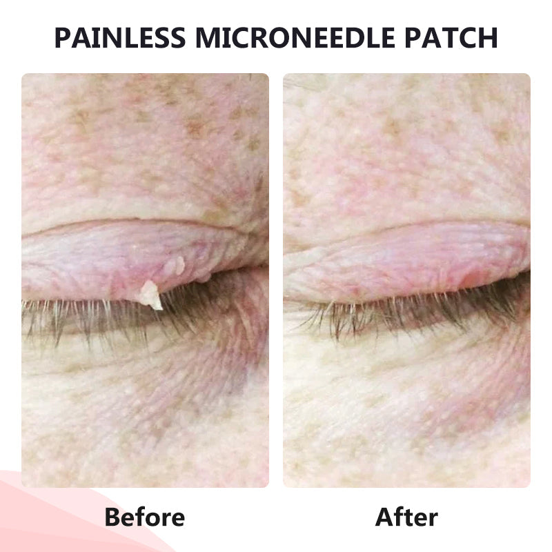 💥painless micro-patch🔥